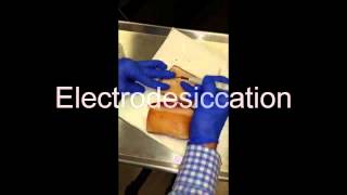 Electrodesiccation and Curettage EDampC  How To [upl. by Walton]