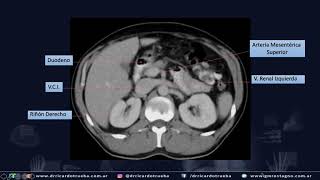 TOMOGRAFIA AXIAL BASICA DE ABDOMEN Y PELVIS [upl. by Isak]