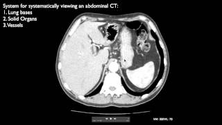 How to interpret an abdominal CT [upl. by Germaine]