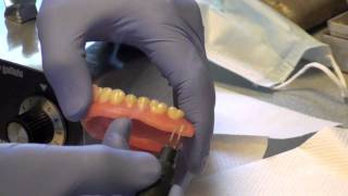 Denture Soft Reline Part 2 [upl. by Sila]