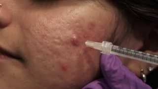 Watch amp Learn Intralesional injections [upl. by Bili38]