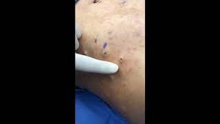 Electrodesiccation Technique for Large Cutaneous Neurofibromas [upl. by Eiramadnil]