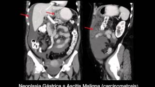 Generalidades de Radiología Abdominal III [upl. by Kohsa732]