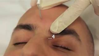 Sebaceous Hyperplasia Treatment using Electrodessication [upl. by Aydne]