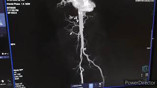 Ct Abdominal Angio Aortic Angiography [upl. by Schaumberger]