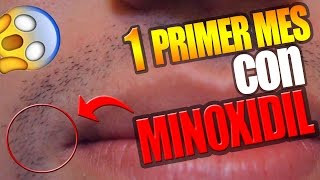 1 primer mes con minoxidil kirkland RESULTADOS VÍCTOR CABALLERO [upl. by Aihsoek]