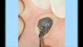 Seborrheic Keratosis Treatment [upl. by Lyns392]