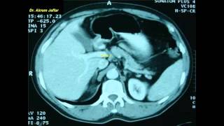 Cross sectional and imaging anatomy of the abdomen [upl. by Amikay]