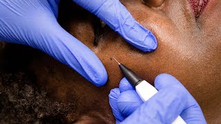 Skin Tags Removal with Electrolysis [upl. by Betty]