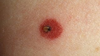 How to Spot Lyme Disease  WebMD [upl. by Gannes]