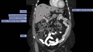 TOMOGRAFIA CORONAL BASICA DE ABDOMEN Y PELVIS [upl. by Jit]