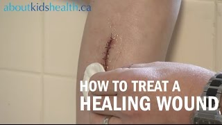 How to care for a healing wound  AboutKidsHealth at The Hospital for Sick Children [upl. by Alric]