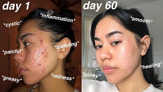 I CLEARED MY ACNE 60 days using Differin Gel Adapalene 01  pictures [upl. by Hornstein]