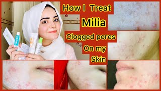 How To Treat Milia Clogged Pores Permanently At Home  Self Experienced  Dietitian Aqsa [upl. by Tenneb]