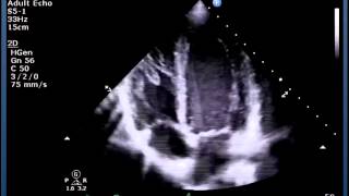 Mastering important TEE views transesophageal echocardiography [upl. by Aydni332]