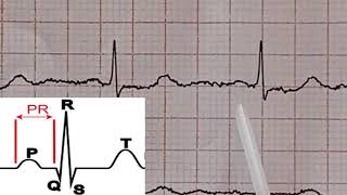 ECG Interpretation tres facile de l ECG 9eme partie Lecture d un ECG Normal [upl. by Junina147]