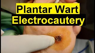 Treatment of Viral Warts  Electrocautery Procedure [upl. by Ednalrim]